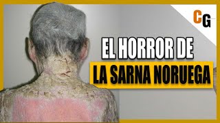 SARNA Sarna Noruega y Sarna Bullosa  Explicación Fisiopatología y Tratamiento de la ESCABIOSIS [upl. by Nyladgam]