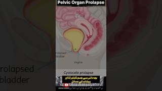 Vaginal Prolapse  Cystocele  Bachadani se Josm ka Baher aana shorts shortsvideo shortsfeed [upl. by Crean]