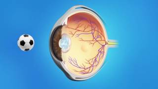 YAG Capsulotomy After Cataract Surgery [upl. by Adiari]