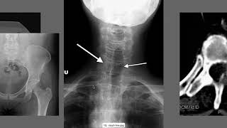 How to Interpret Lumbar XRay Images  How to Read Spine Xrays  How to Read Spine Imaging [upl. by Durtschi]