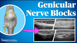 Ultrasound Guided Genicular Blocks 2024 update [upl. by Zoeller]