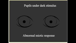 Paradoxical Pupillary Response [upl. by Salahi]