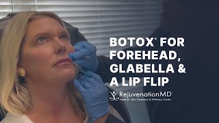 Lip Flip With Botox [upl. by Elirpa]