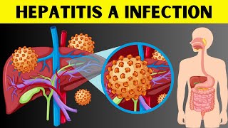 Hepatitis A Infection  Signs amp Symptoms Risk Factors Virology Diagnosis And Treatment [upl. by Kennet]