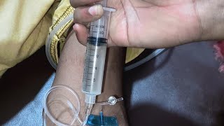 Intravenous injection Iv ceftriaxone Triporce 1g  injection video 24 P15 by cannula sixtynine [upl. by Frayda]