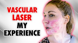 My FIRST time Trying the VASCULAR LASER Here’s What I Learned [upl. by Suilenrac]