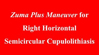 Zuma Plus Maneuver for Right Horizontal Semicircular Cupulolithiasis [upl. by Tansey]