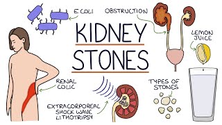 Understanding Kidney Stones [upl. by Neelram599]