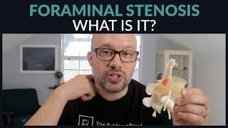 What is Foraminal Stenosis [upl. by Ingles]