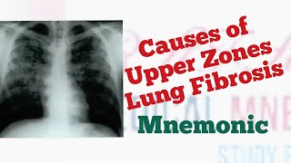 Upper Lobe Lung Fibrosis Causes Mnemonic by MedSurvival [upl. by Eednyl]