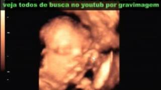 GRAVIMAGEM 61 ultrasom gravidez 20 semanas 3d 4d [upl. by Ruthven]