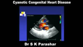 Cyanotic Congenital Heart Disease Dr S K Parashar [upl. by Aronaele617]