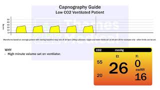 Capnography Waveforms Low CO2 Ventilated Patient [upl. by Cutcheon]