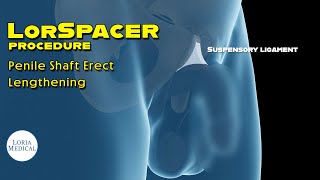 Suspensory Ligament Release procedure How its done [upl. by Areehs121]