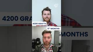 FUE Hair Transplant Results Month by Month  4200 GRAFTS 🫨 [upl. by Leelah]