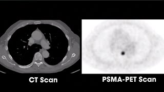 What is PSMAPET Scan Radioactive Imaging [upl. by Karita]