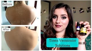 Tinea Versicolor SOLUTIONS TNBeauty94 [upl. by Ovatsug]