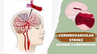 Cerebrovascular accident or stroke  Ischemic and hemorrhagic [upl. by Derward781]