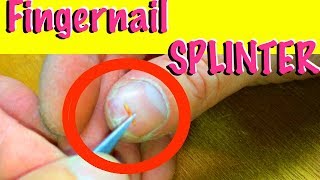 Pulling a nasty Splinter under Fingernail  How to [upl. by Elleon]