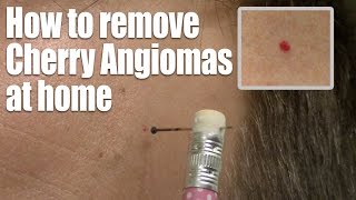 How to remove Red Skin Dots at home Quick amp Easy Cherry Angioma treatment [upl. by Urita]