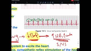 ECG 3 Arrhythmias  CVS Lecture 5 [upl. by Landrum]