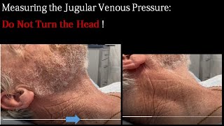 Anatomy of Procedure of External Jugular Venous Pressure [upl. by Etterrag]