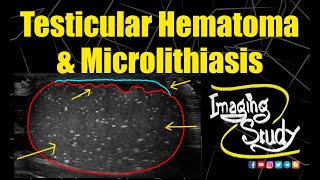 Testicular Hematoma amp Microlithiasis  Ultrasound  Case 205 [upl. by Irakab]