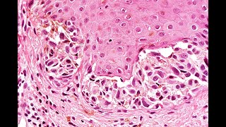 Atypical nevi Part 1 Neonatal nevi and nevus of specal sites Phillip H McKee [upl. by Attevaj973]