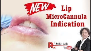 NEW Lip Filler MicroCannula Injection Indication Dr Rajani Style Aesthetics in Portland Oregon [upl. by Amles664]