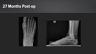 Hallux Rigidus Treatment With ArthroFLEX® Dermal Allograft [upl. by Louise]