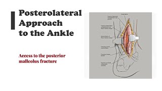 Posterolateral Approach to the Ankle [upl. by Arun]