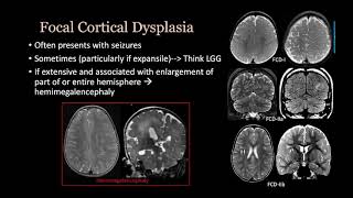 imaging Congenital malformation Brain and spine [upl. by Kinna]