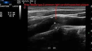 placca ipoecogena alla carotide comune destra Tipo 2 GrayWeale [upl. by Amehr]