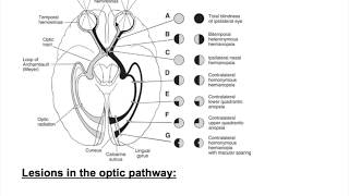 Optic nerve lesions Bitemporal hemianopia heteronymous hemianopiaHomonymous hemianopia [upl. by Mathian788]