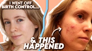 Spironolactone How I Cleared My Hormonal Acne  Tretinoin  Before amp After Side Effects Results [upl. by Druce]