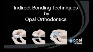 Indirect Bonding by Opal Orthodontics [upl. by Urbanna]