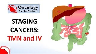 Staging cancers TNM and IIV systems [upl. by Ecirb]