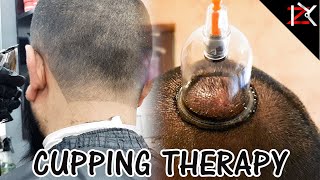 How To Cure Headaches  Wet Cupping Therapy Performed  Migraine Treatment  Hijama  THIS WORKED [upl. by Nylesoy]