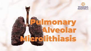 Pulmonary Alveolar Microlithiasis  PAM  Yashoda Hospitals Hyderabad [upl. by Pandolfi]