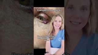 What to know about basal cell carcinoma [upl. by Tebasile904]