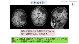 治験市民講座「てんかん治療と診断の最前線」：最新の治療や治験 [upl. by Golanka]