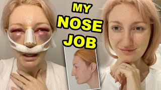 MY NOSE JOB  PART 1  RHINOPLASTY amp SEPTOPLASTY SURGERY amp RECOVERY 2020 [upl. by Sapphera]