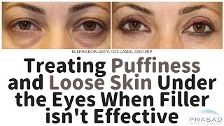 How to Treat Constantly Puffy Eyes and Loose Under Eye Skin When Filler Doesnt Work [upl. by Austine]