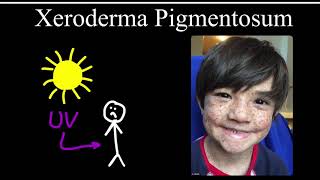 Xeroderma Pigmentosum [upl. by Nwahsirhc]