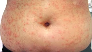 Miliaria Heat Rash  All 3 types  How to treat [upl. by Thad]