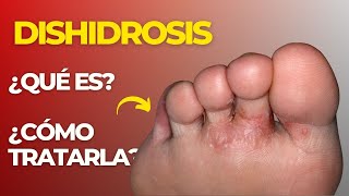 🚨 ¿DISHIDROSIS EN PODOLOGIA ¿Qué es y ¿Cómo TRATARLA👀 [upl. by Robinia]