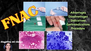 237Fine Needle Aspiration Biopsy  fine needle aspiration cytology fnac surgeryeducation fnac [upl. by Drucilla483]