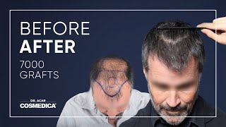 Hair Transplant in Turkey  Results  Dr Acar  Cosmedica Clinic [upl. by Llebiram]