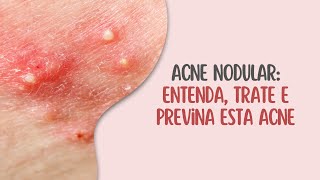 Acne Nodular Entenda Trate e Previna Esta Acne [upl. by Nylimaj]