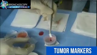 Tumor Markers and EBUS [upl. by Danzig]